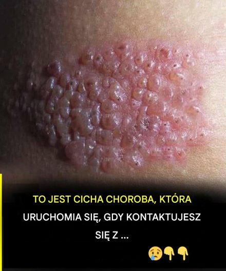 Mało kto wie o tej cichej chorobie, która może pojawić się bez ostrzeżenia