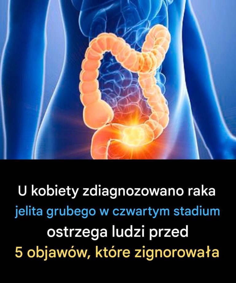 Kobieta ujawnia 5 objawów raka jelita grubego, których nie należy ignorować