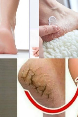 Ten naturalny środek pomoże Ci zwalczyć popękane pięty już w ciągu nocy!!!!Pełna lista w pierwszym