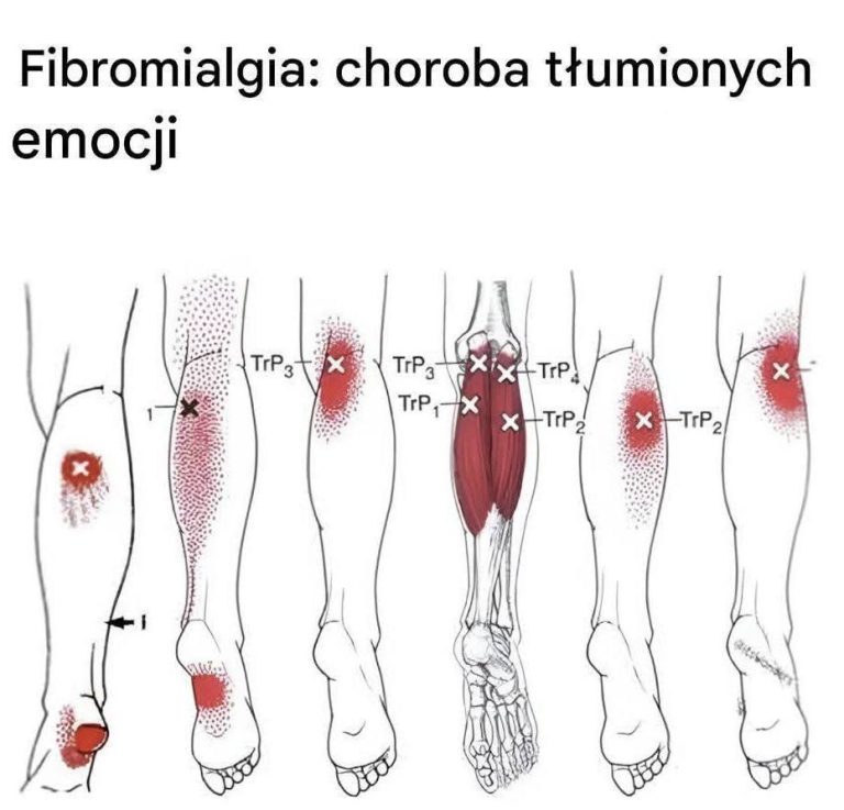 Jaki jest związek pomiędzy fibromialgią a emocjami?
