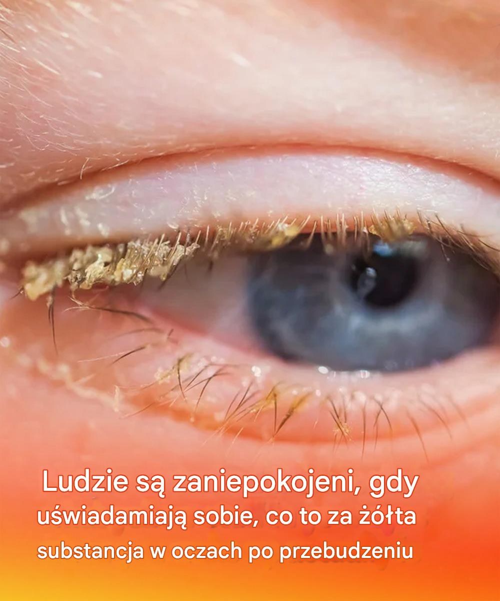 Ludzie są zaniepokojeni, gdy uświadamiają sobie, co to za żółta substancja w oczach po przebudzeniu