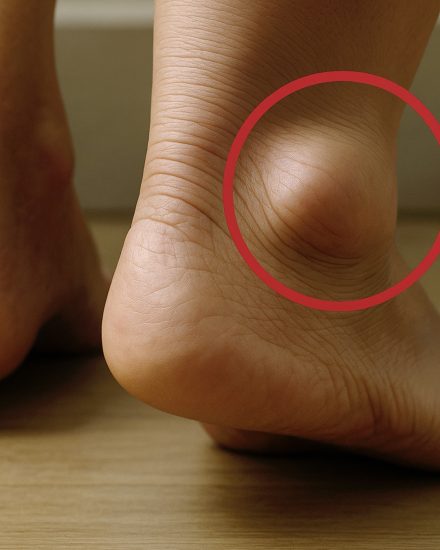 Opuchnięte nogi: poznaj objawy, przyczyny i metody leczenia