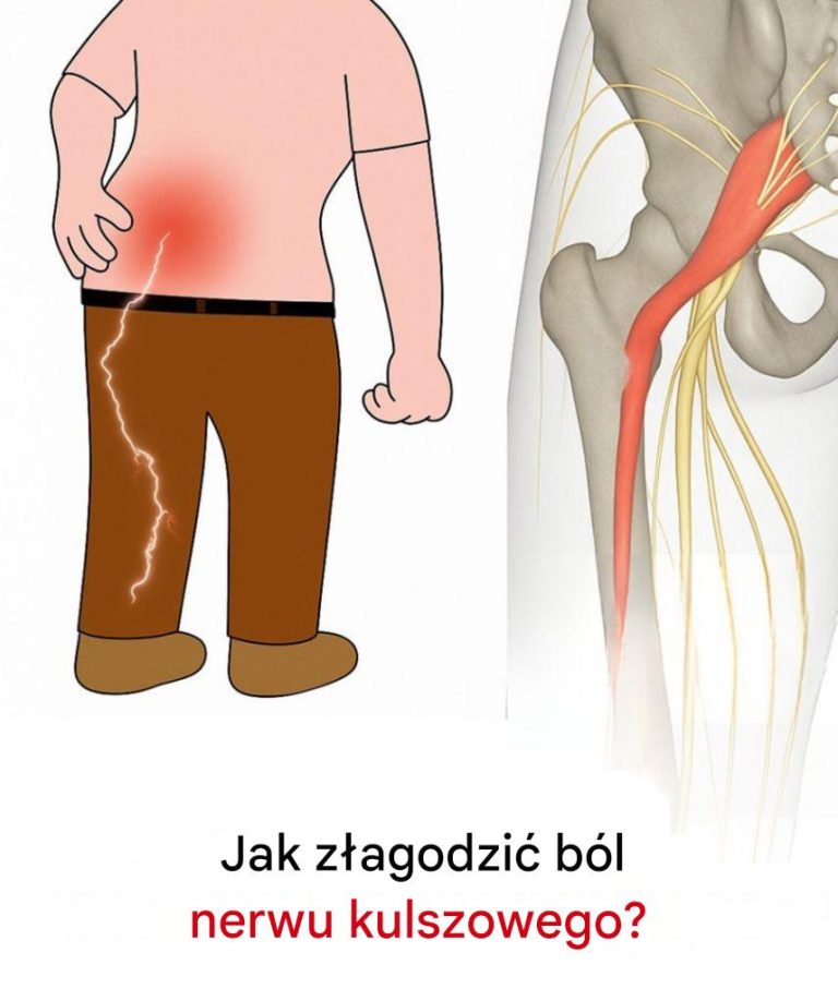 3 ćwiczenia łagodzące ból nerwu kulszowego