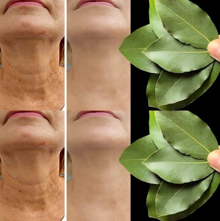 Liść laurowy jest 100 000 razy silniejszy niż botoks? | Naturalny środek na zmarszczki nawet w wieku 70 lat!